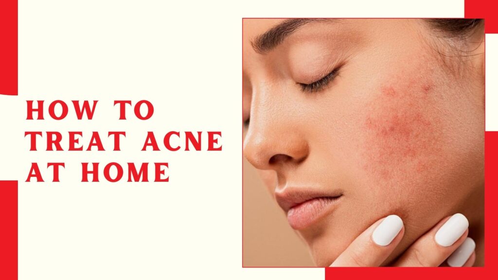 How to Treat Acne at Home