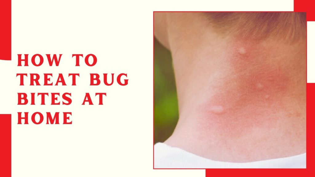 How to Treat Bug Bites at Home