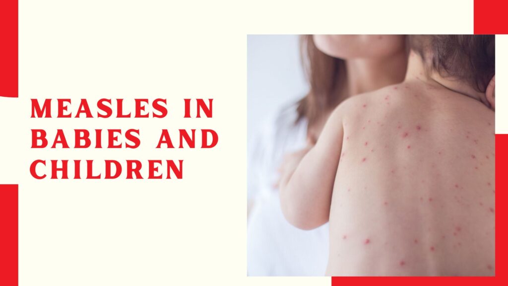 Measles in babies and children