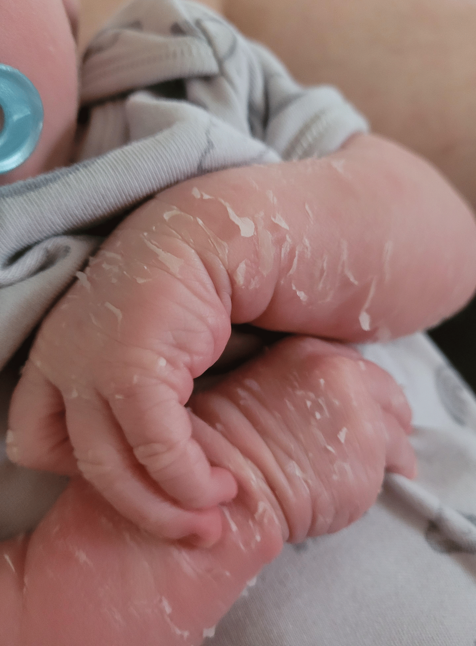 peeling skin
