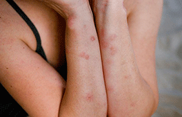 Bed bug bites