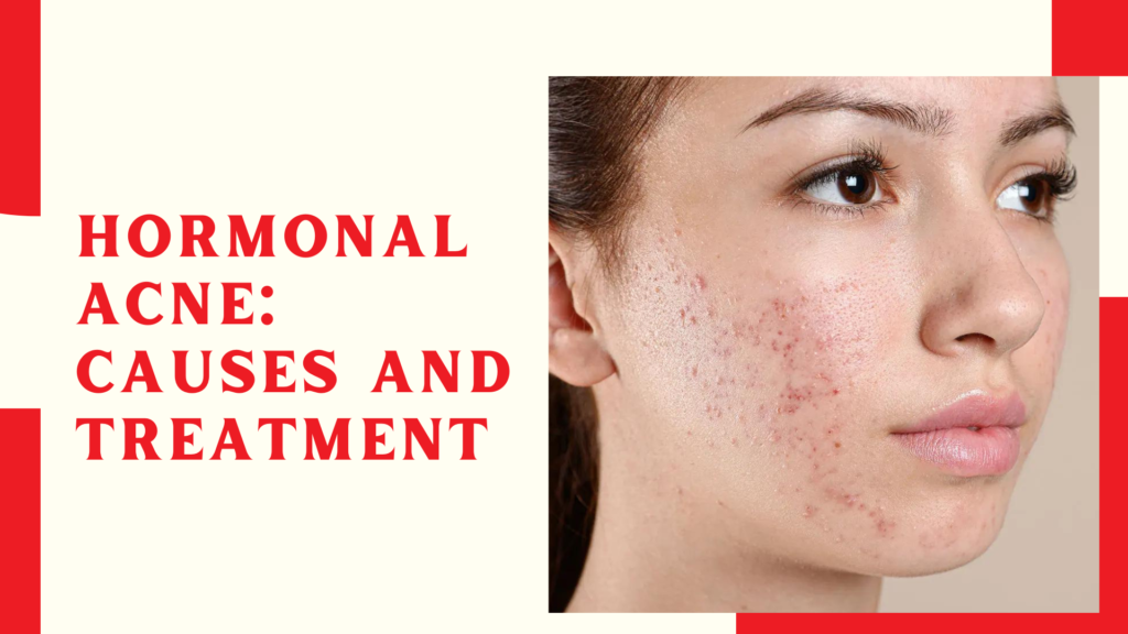 Hormonal Acne: Causes and Treatment