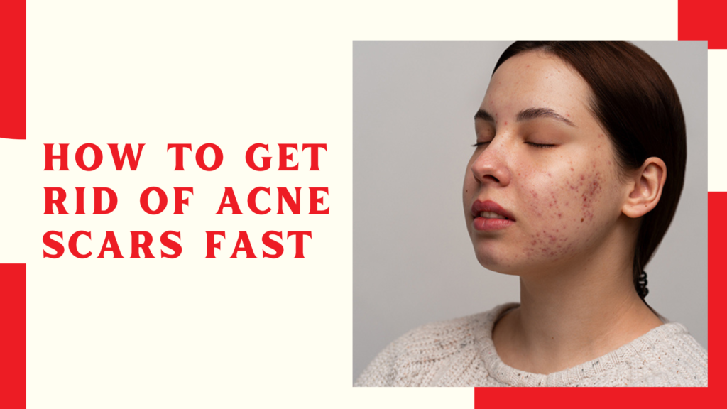 How to Get Rid of Acne Scars Fast