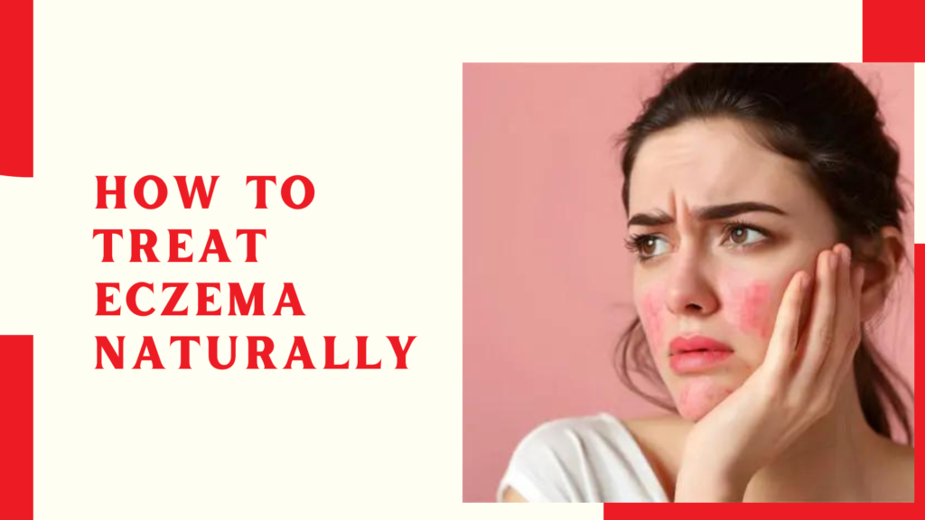 How to Treat Eczema Naturally