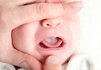 Oral thrush causes white blisters on your baby's lips