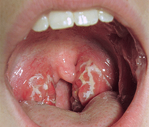 Strep-throat