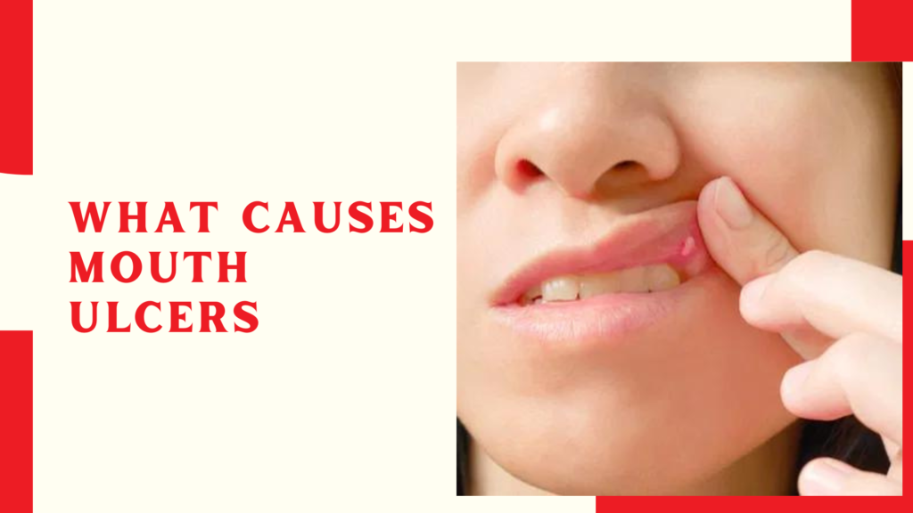 What Causes Mouth Ulcers