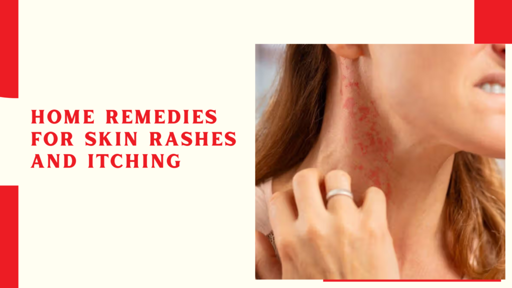 Home remedies for skin rashes and itching