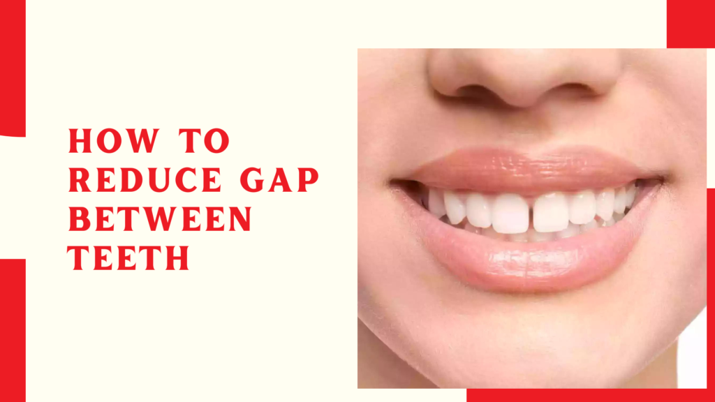 How to Reduce Gap Between Teeth