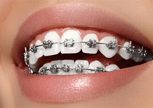 Orthodontic-Treatments