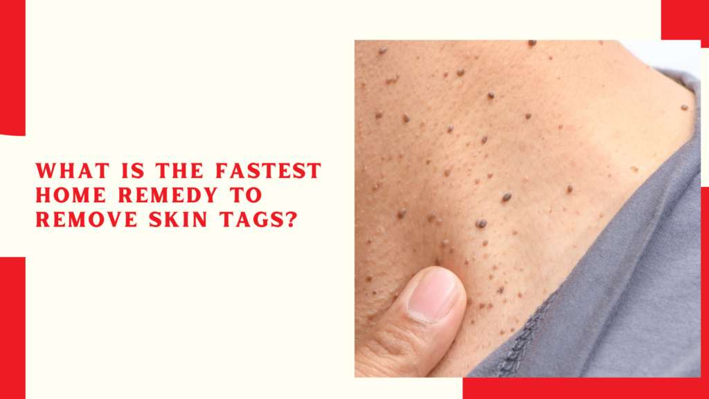 What is the fastest home remedy to remove skin tags?