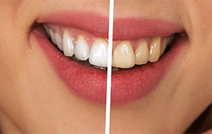 What's the real difference between LED vs. laser Teeth Whitening