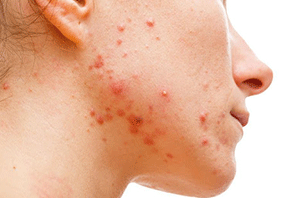 Causes of Acne