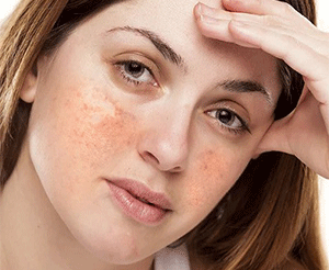 What Causes Melasma?